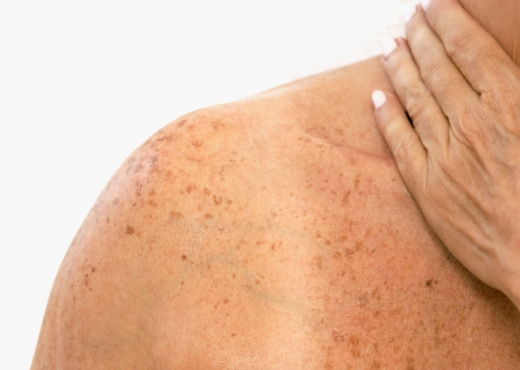 Para o câncer de pele melanoma os principais fatores de risco são: pele clara, exposição excessiva ao sol e hereditariedade (Foto: Gazeta Toledo)